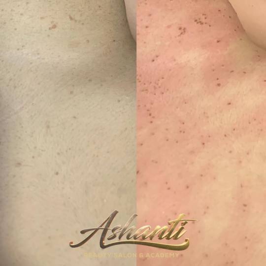 Ashanti Beauty Salon & Academy #beograd Tretman lica Uklanjanje virusnih bradavica