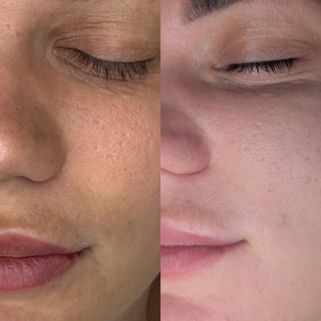 Dermapen lica - Brow & Glow, Novi Sad Tretman lica Lice Tretman lica, Novi Sad, Veternik