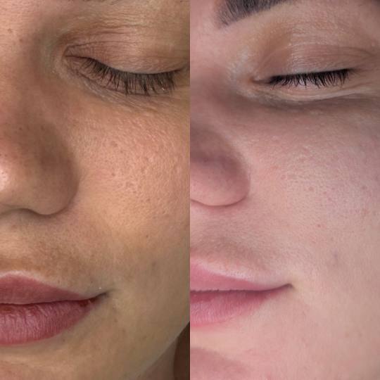 Brow & Glow #novisad Tretman lica Dermapen lica Ako su ti problem bore, ožiljci, hiperpigmentacije,