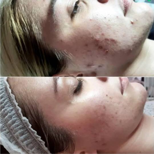 Nirvana Health and Beauty Studio #beograd Dermaroler i dermapen Dermapen tretman lica Kimbinacija hi