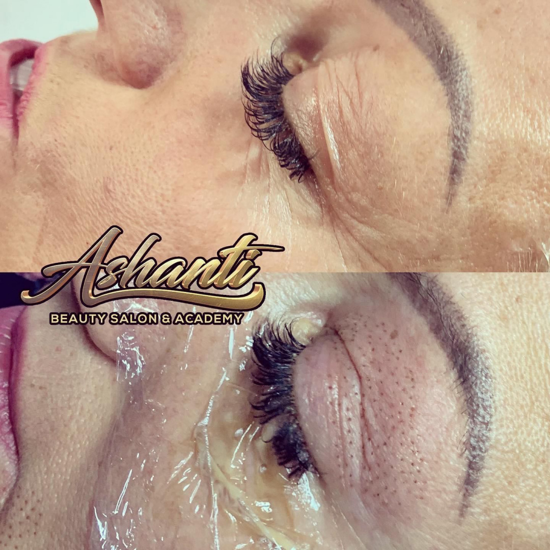 Plasma pen - gornji kapci - Ashanti Beauty Salon & Academy, Beograd Tretman lica Lice Tretman lica, Beograd, Voždovac
