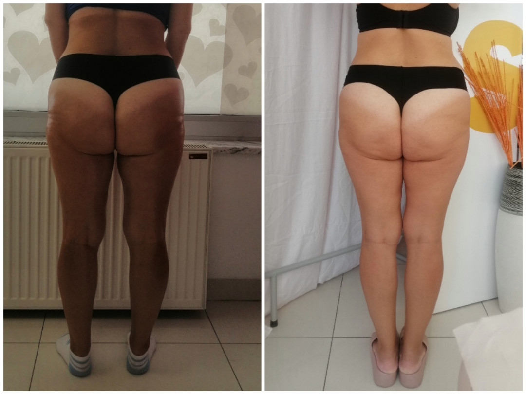 Lipolaser Centar - Matrix021 #novisad Tretmani tela