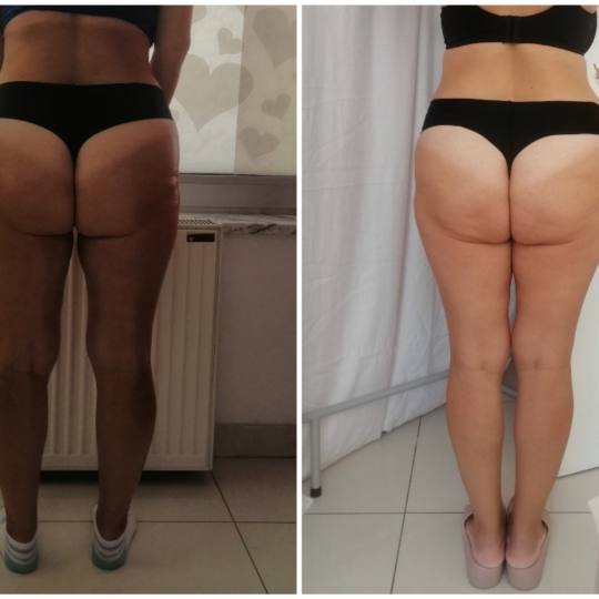 Lipolaser Centar - Matrix021 #novisad Tretmani tela Pre i posle samo drugog tretmana rezultati su ne