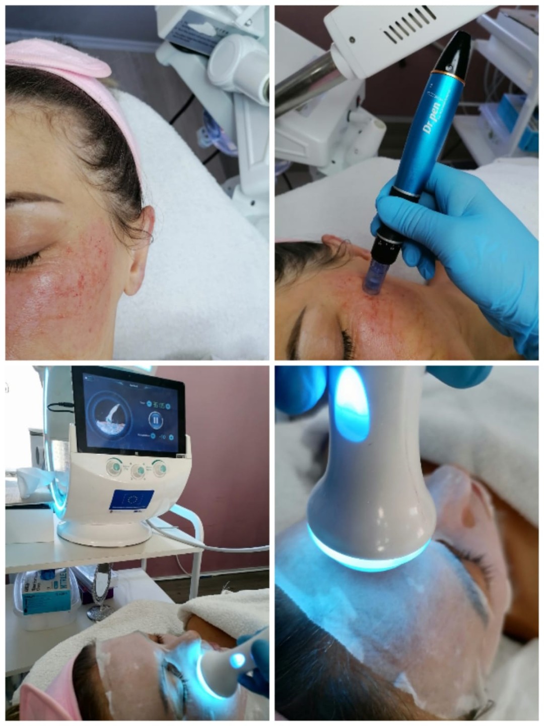The oriental spa #prijepolje Tretman lica Microlending- Derma pen