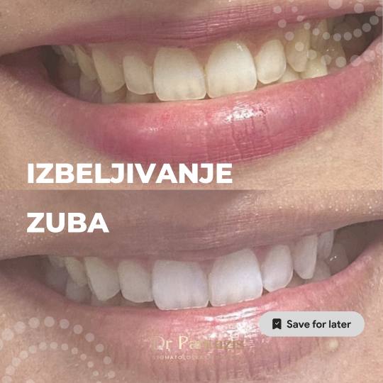 Dr Pantazis - Dental & Beauty Clinic #beograd Zubi Lasersko Profesionalno Izbeljivanje Zuba