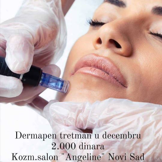 AngeLine #novisad Dermapenom do savrsene koze
