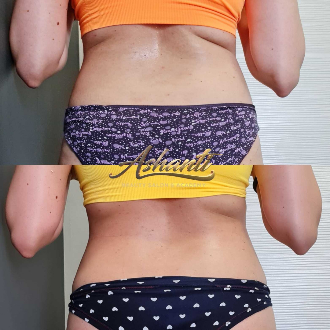 Ashanti Beauty Salon & Academy #beograd Masaža za mršavljenje Dermapen - regija lica