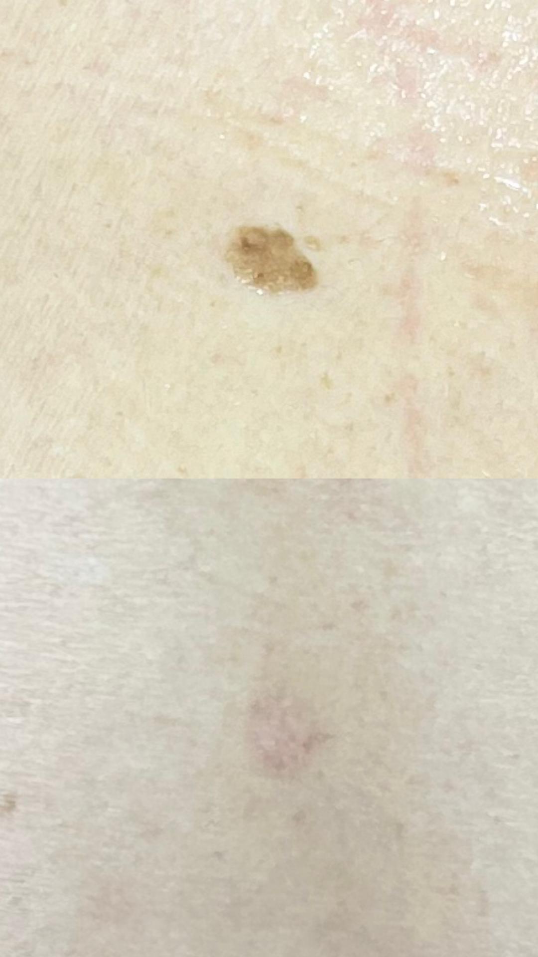 Belle Ana #beograd Tretman lica Phi-Ion tretman - bradavice / papilomi / keratoze / milije / hiperpigmentacija