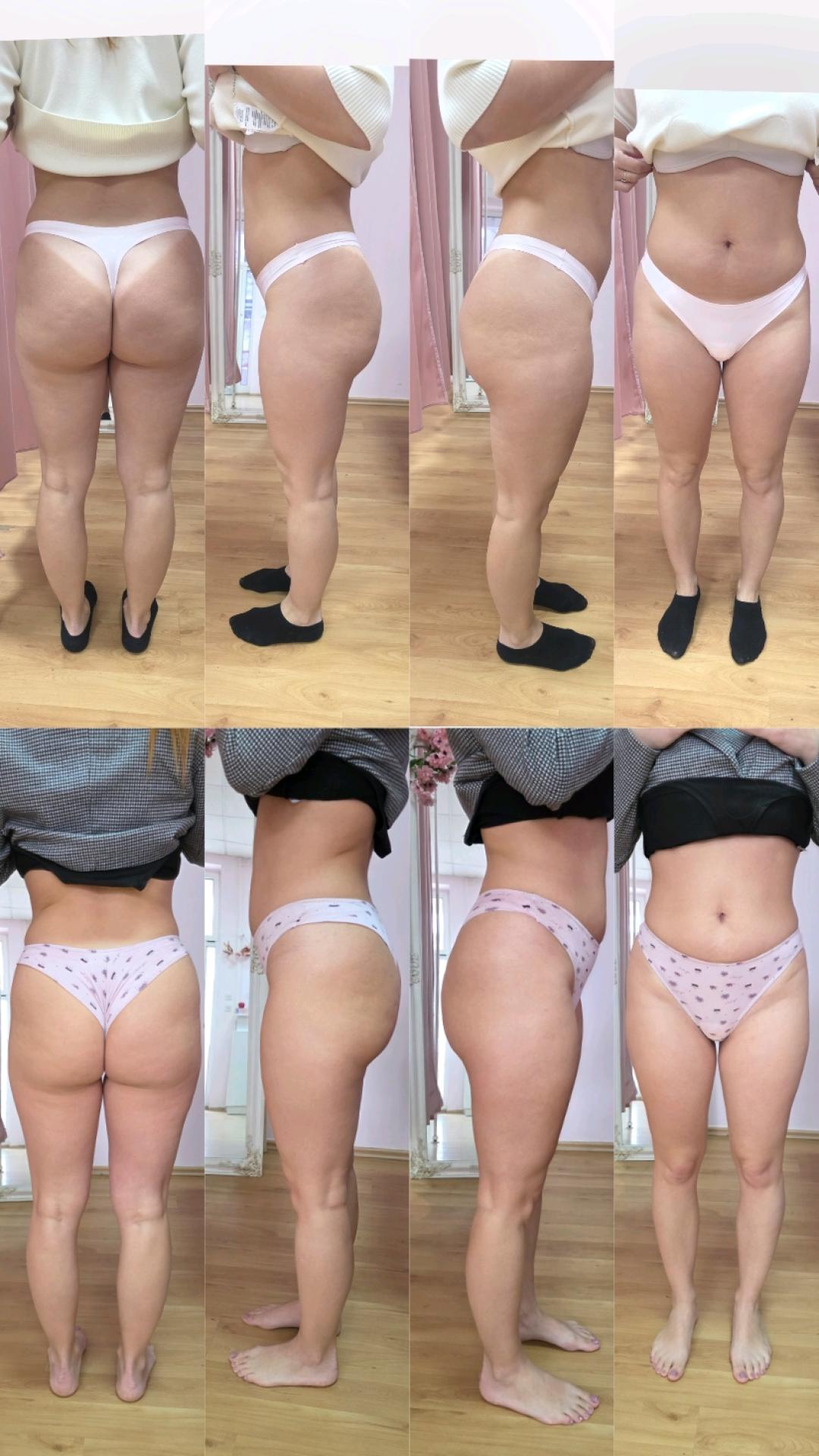 LUX 10 maderoterapije+10 limfne drenaze+ brazilske madero+10 pakovanja - Mademoiselle Natalie studio, Beograd Anticelulit Telo Anticelulit, Beograd, Novi Beograd Arena