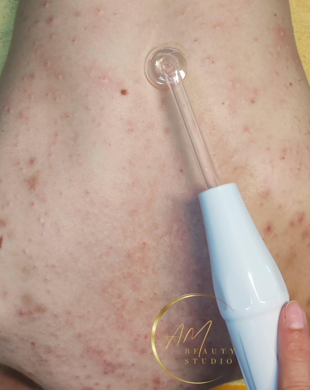 AM BEAUTY STUDIO #odzaci Tretmani tela Higijenski tretman leđa