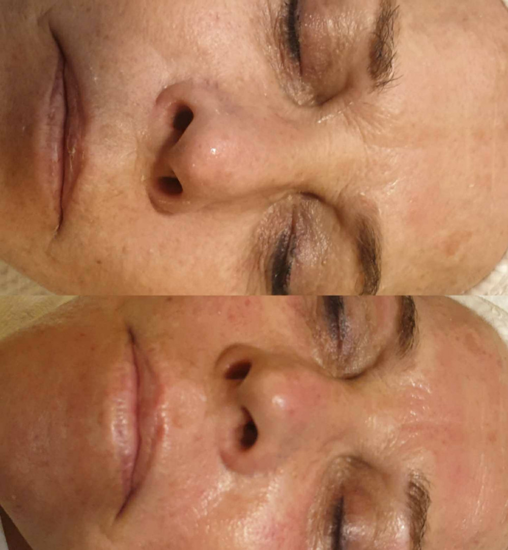 Boho Body N Soul studio #beograd Lifting / zatezanje kože Dermapen tretman lica sa serumima
