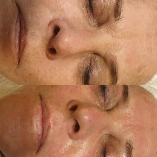 Boho Body N Soul studio #beograd Lifting / zatezanje kože Dermapen tretman lica sa serumima Dermape