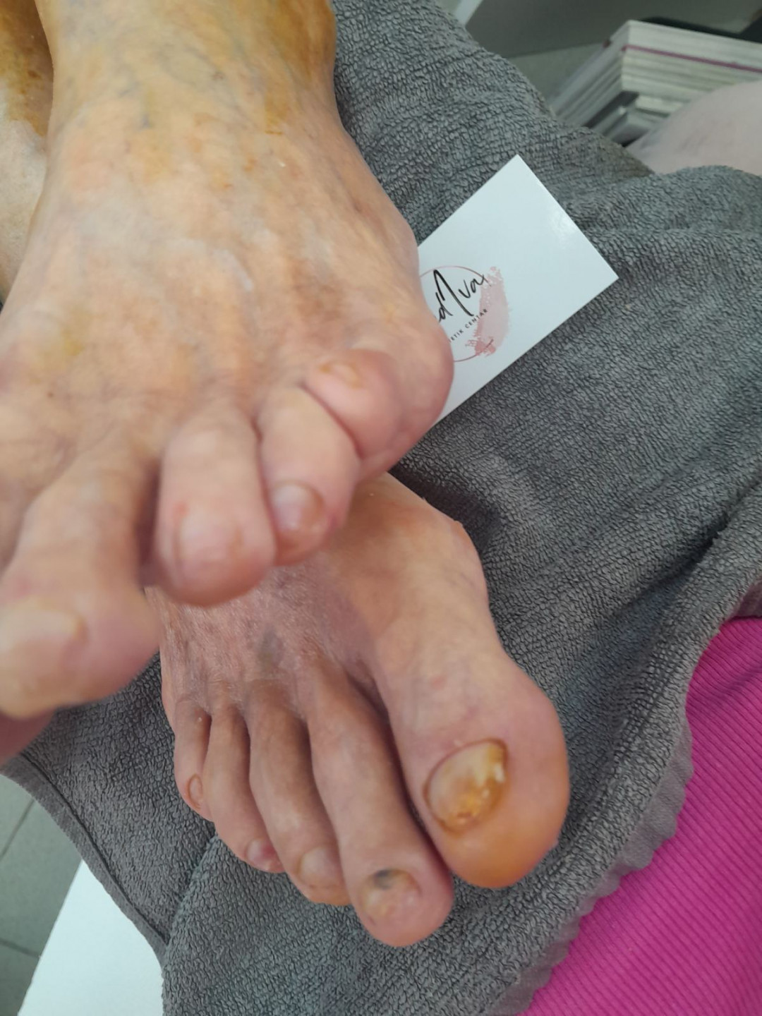 Mediva Estetik #beograd Medicinski pedikir Medicinski pedikir manje problematican