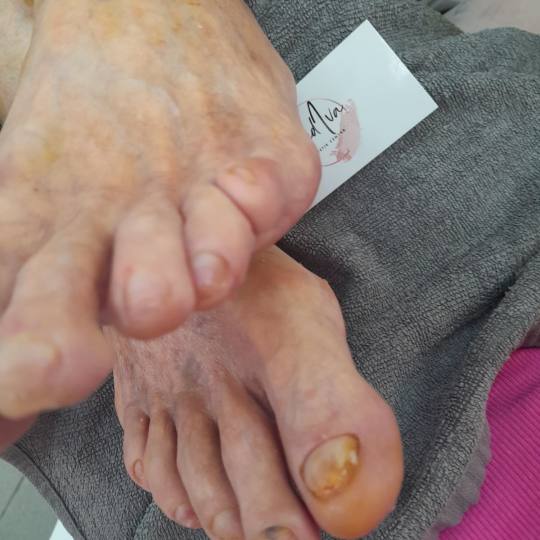 Mediva Estetik #beograd Medicinski pedikir Medicinski pedikir manje problematican Pomažemo Vam u le