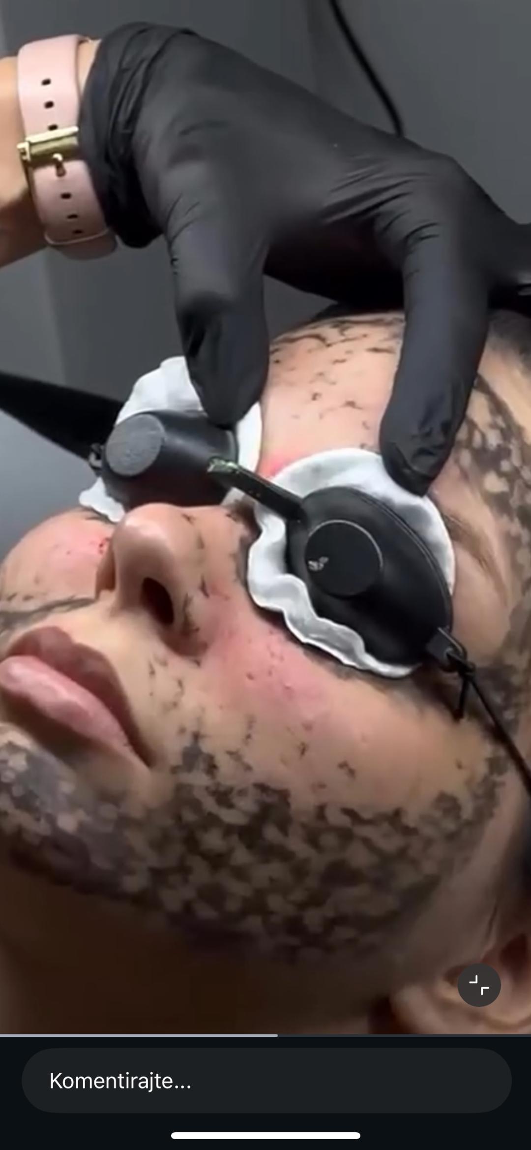 Belle Ana #beograd Tretman lica Karbon piling lica