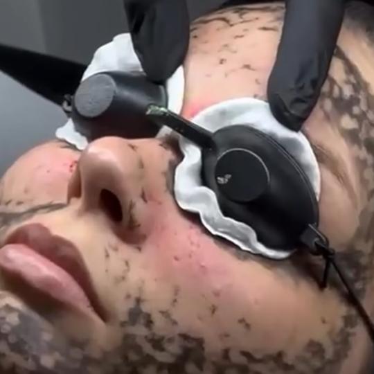 Belle Ana #beograd Tretman lica Karbon piling lica Karbon piling (holivudski piling) je brz, bezbola