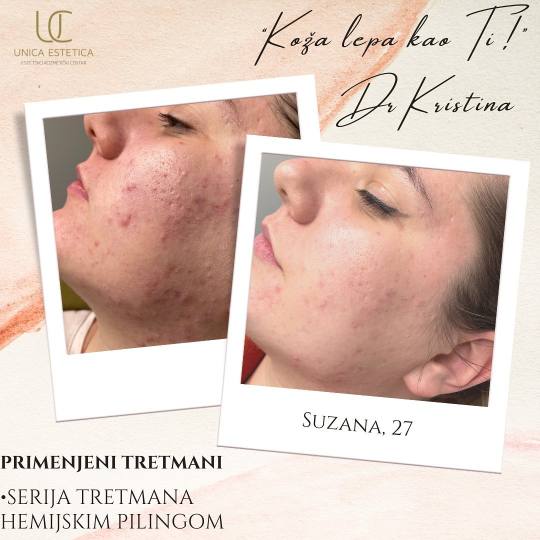 Unica Estetica #nis Tretman lica TCA hemijski piling lica 👉🏼Kod Suze, imamo jedan lagan i rela