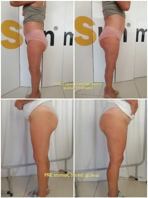 Lipolaser Centar - Matrix021 #novisad Tretmani tela