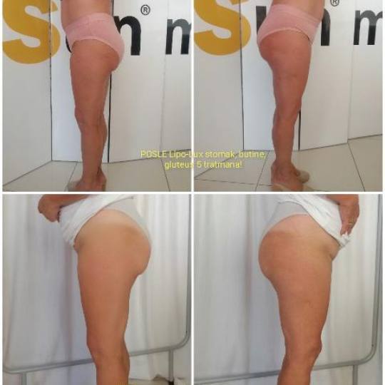 Lipolaser Centar - Matrix021 #novisad Tretmani tela Lipo-Lux je najbolji mogući paket koji je poseb