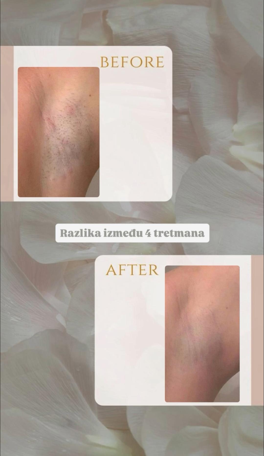 Vanilla rain beauty - Banovo brdo #beograd Laserska epilacija Laserska epilacija pazuha - za dame