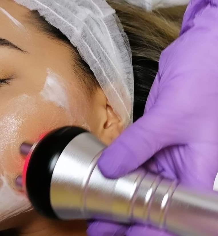 Knez Alfaparf Milano #beograd Tretman lica Radiotalasi lica