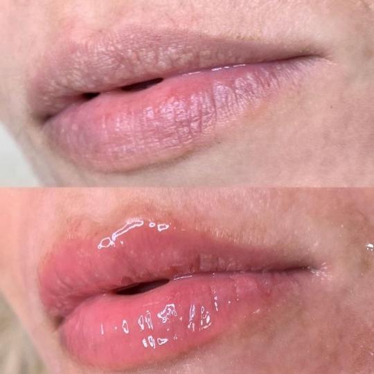 L’Avenue #beograd Mezoterapija lica Hydralips-mezoterapija usana hijaluronom