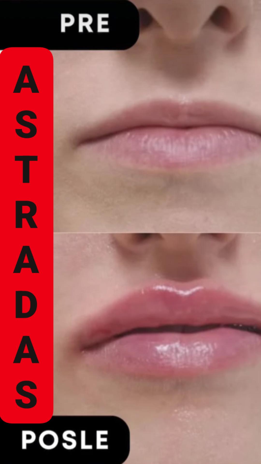 Uvećanje usana filerima - 0,5 cc - Astradas 2, Beograd Hijaluronski tretmani lica Lice Hijaluronski tretmani lica, Beograd, Novi Beograd blokovi, Belville, Savski kej