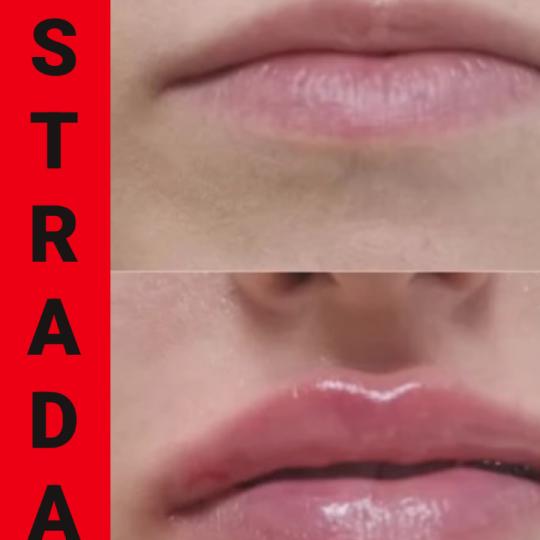 Astradas 2 #beograd Hijaluronski tretmani lica Uvećanje usana filerima - 0,5 cc Tretman uvecanje us