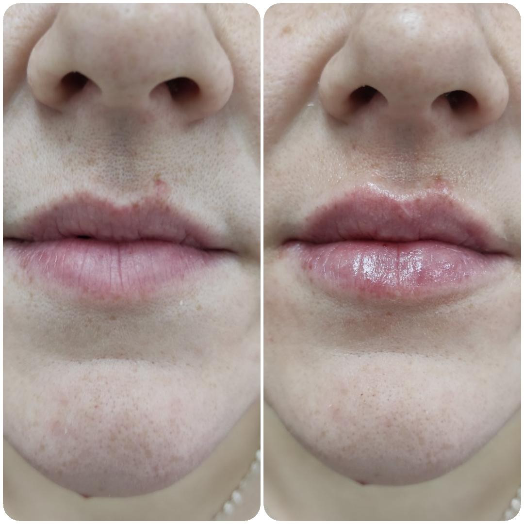 Ordinacija Stanojlović #krusevac Dermalni fileri Hijaluronski filer 0.5 ml - uvećavanje usana