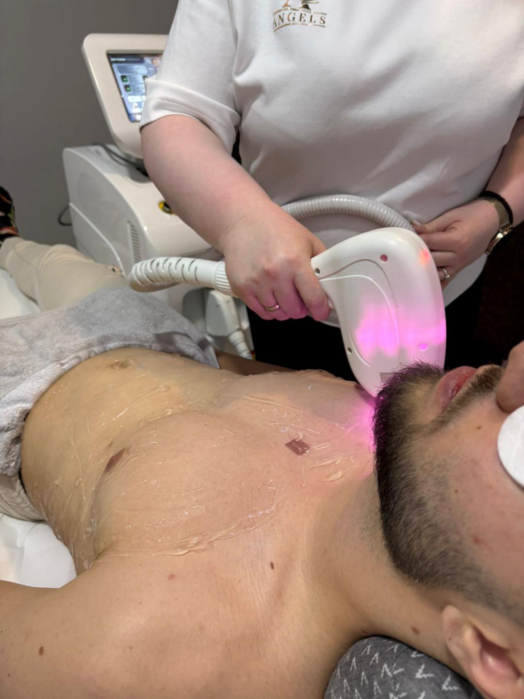 Angels #novisad Laserska epilacija Laserska epilacija grudi + stomak - za muškarce