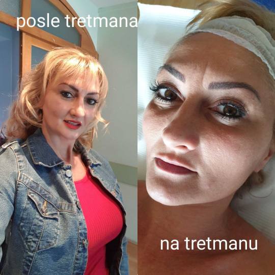 Tina B #beograd Tretman lica PRP Dermapen