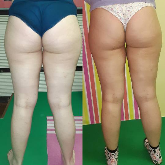 Migun centar relax #beograd Anticelulit masaža Maderoterapija noge + gluteus+stomak 50 min. Masaza 