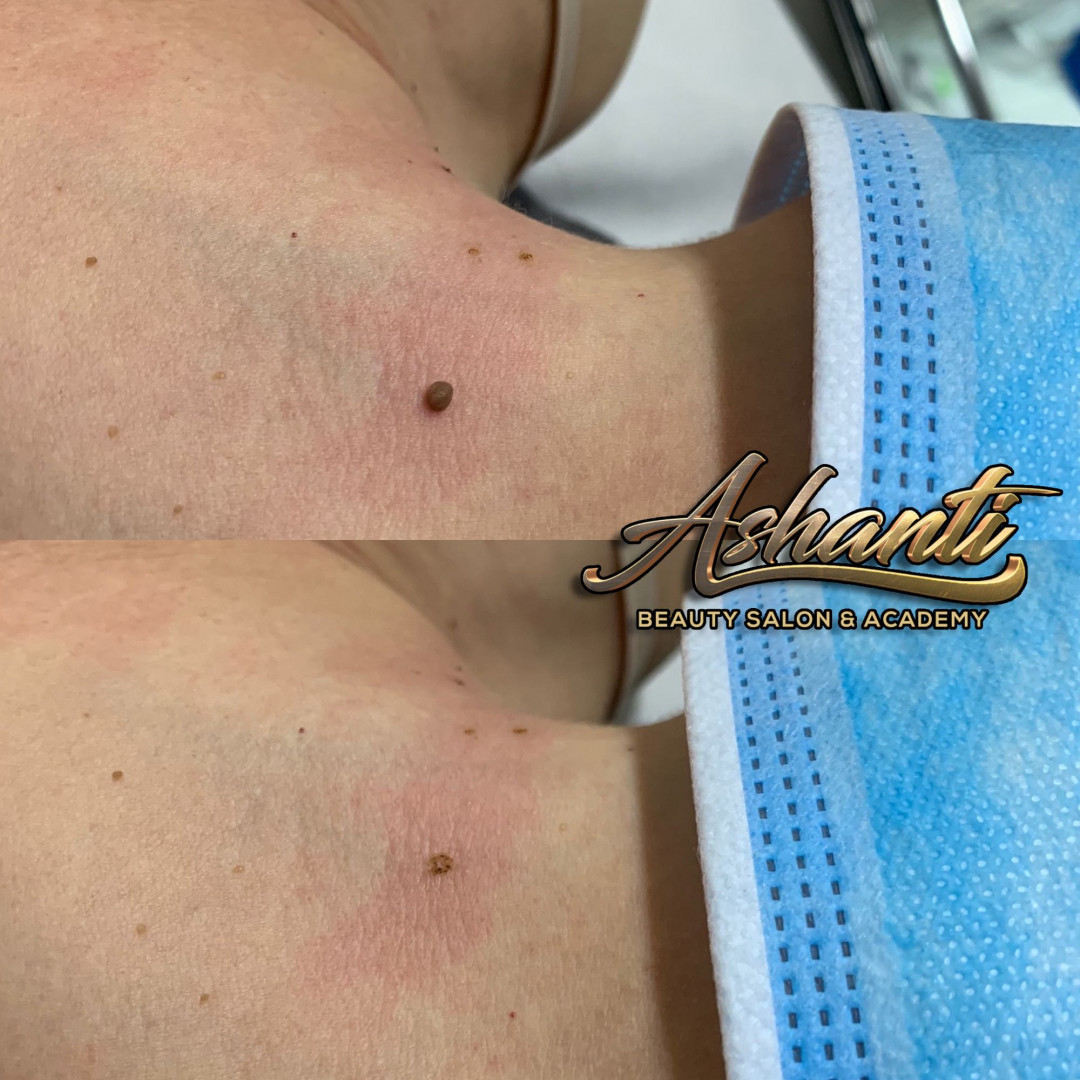 Plasma pen - skidanje 1 bradavice - Ashanti Beauty Salon & Academy, Beograd Tretman lica Lice Tretman lica, Beograd, Voždovac