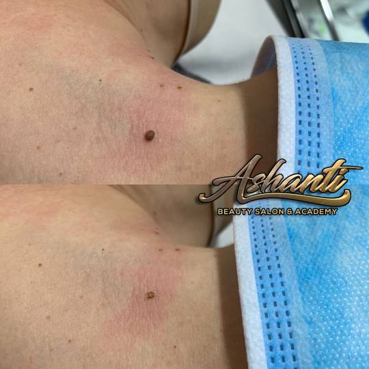 Ashanti Beauty Salon & Academy #beograd Tretman lica Plasma pen - skidanje 1 bradavice