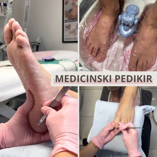 Beauty in Style DM #novisad Medicinski pedikir Medicinski pedikir -urasli nokti, žuljevi, kurije o