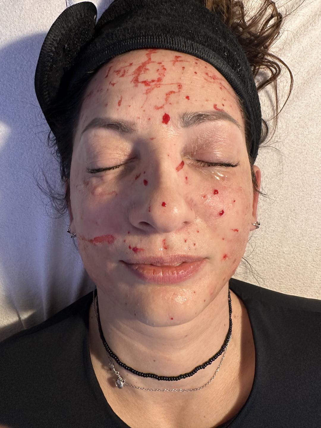 Beauty & Fashion #beograd Tretman lica PRP lica - sa hijaluronskom kiselinom