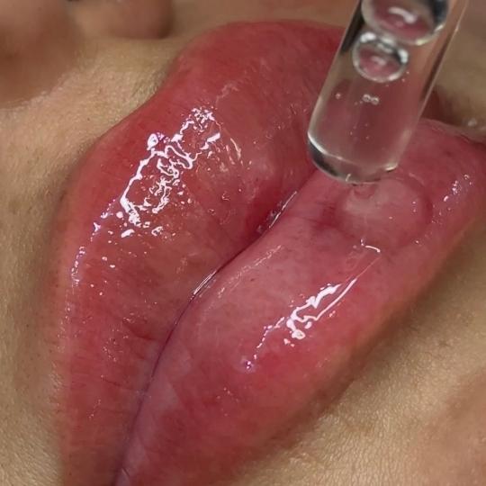 L’Avenue #beograd Mezoterapija lica Hydralips-mezoterapija usana hijaluronom