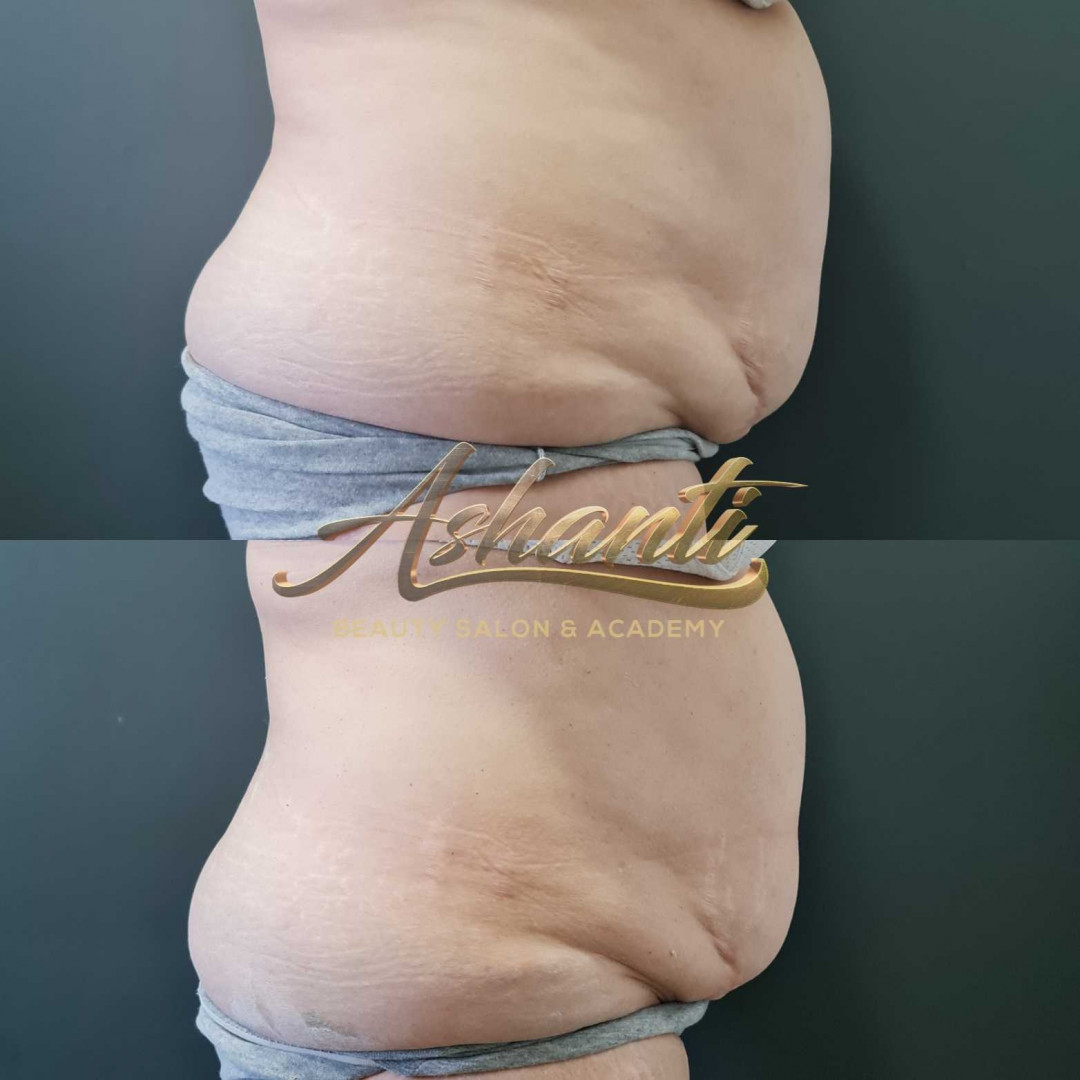 Ashanti Beauty Salon & Academy #beograd Tretmani tela Ice Body Sculpting