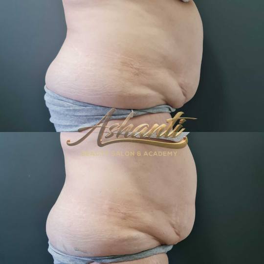 Ashanti Beauty Salon & Academy #beograd Tretmani tela Ice Body Sculpting