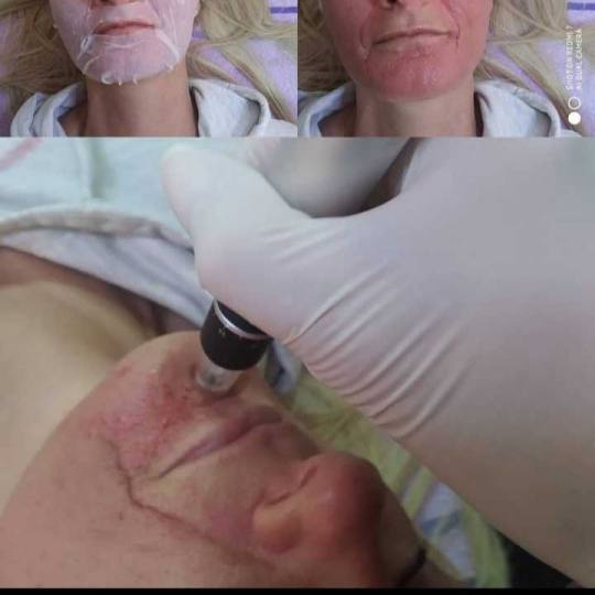 AltaBella Batajnica #beograd Tretmani tela Lasersko podmlađivanje vrata / dekoltea apliciranje hija