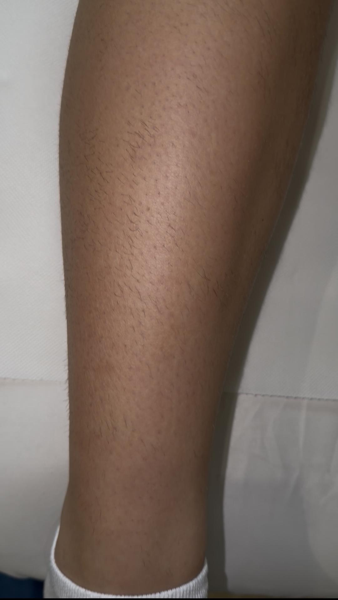 La Hermosa Beauty Studio #beograd Laserska epilacija Laserska epilacija celih nogu - za dame