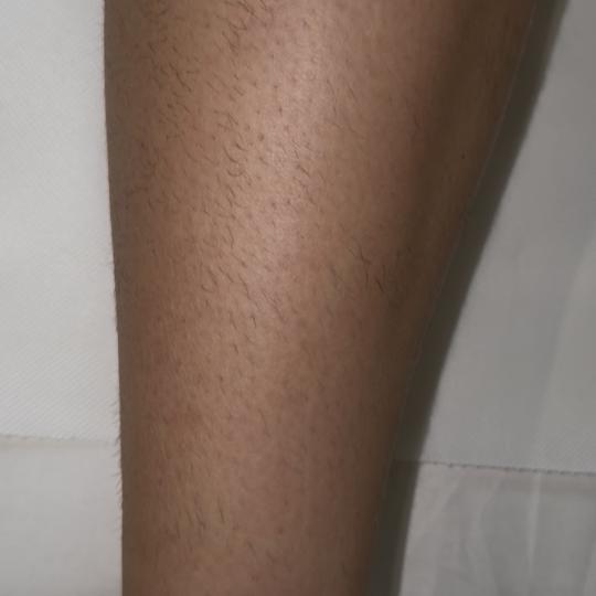 La Hermosa Beauty Studio #beograd Laserska epilacija Laserska epilacija celih nogu - za dame Noge me