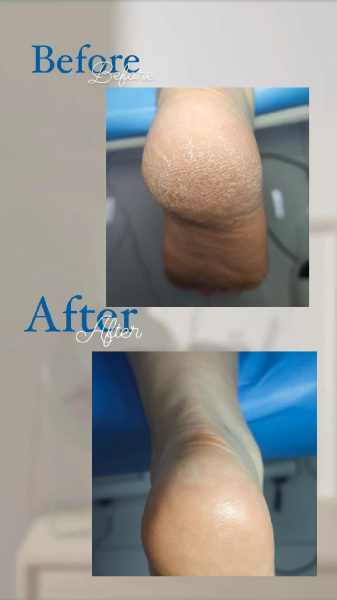 Medicinski pedikir - osnovni - Princess beauty, Niš Medicinski pedikir Nokti Medicinski pedikir, Niš, Palilula