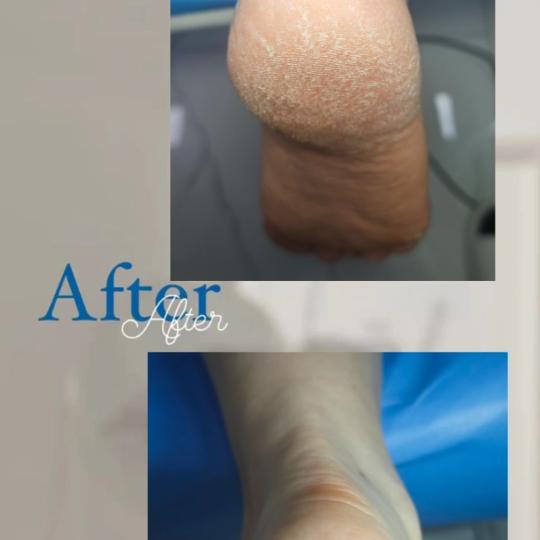 Princess beauty #nis Medicinski pedikir Medicinski pedikir - osnovni