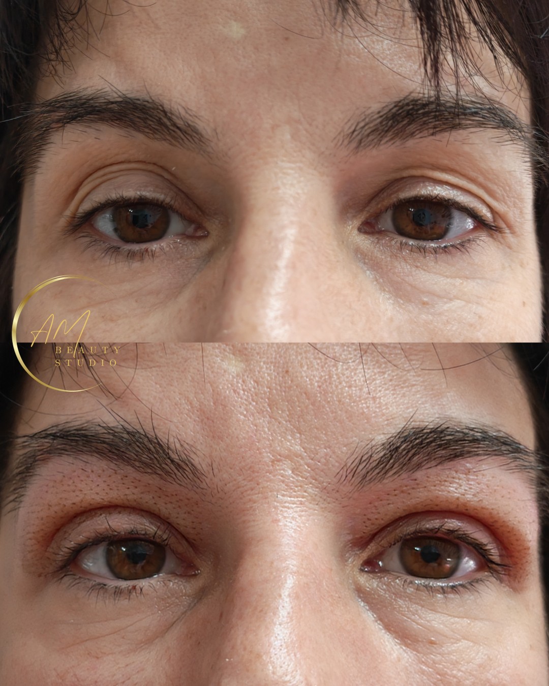 AM BEAUTY STUDIO #odzaci Radiotalasni i ultrazvučni tretmani Plasma pen - gornji kapci