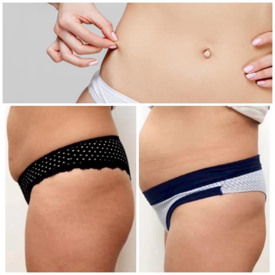 Belle Ana #beograd Kavitacija Kavitacija - stomak