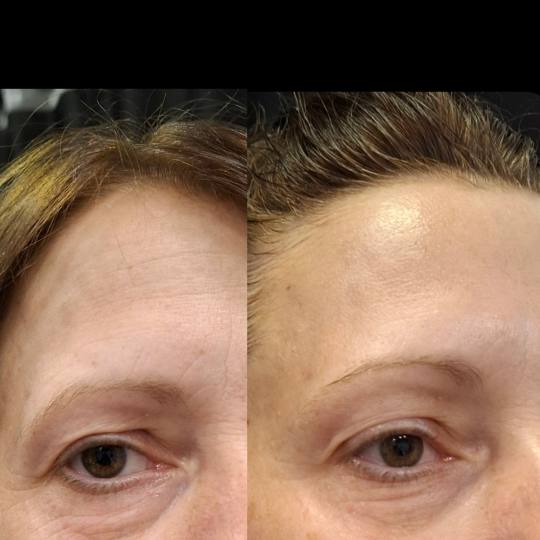 Voyage beauty #beograd Tretman lica Dijamantska mikrodermoabrazija + radiotalasni lifting lica + ult