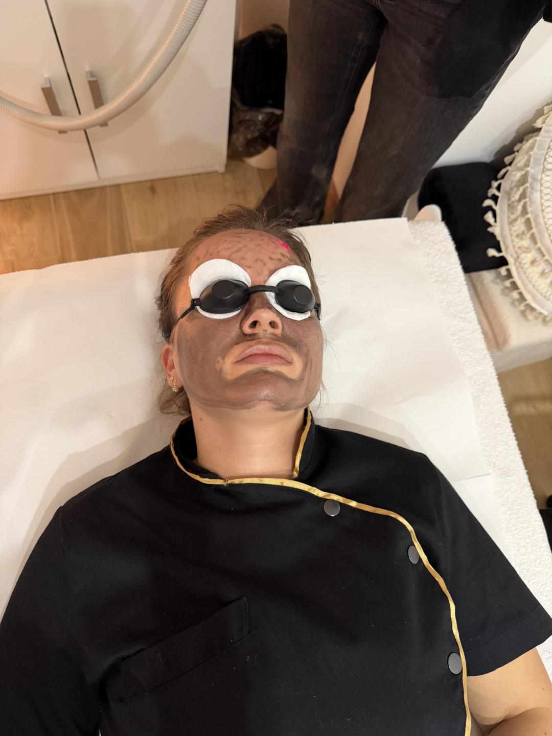 La Hermosa Beauty Studio #beograd Laserski tretmani lica Karbonski piling lica