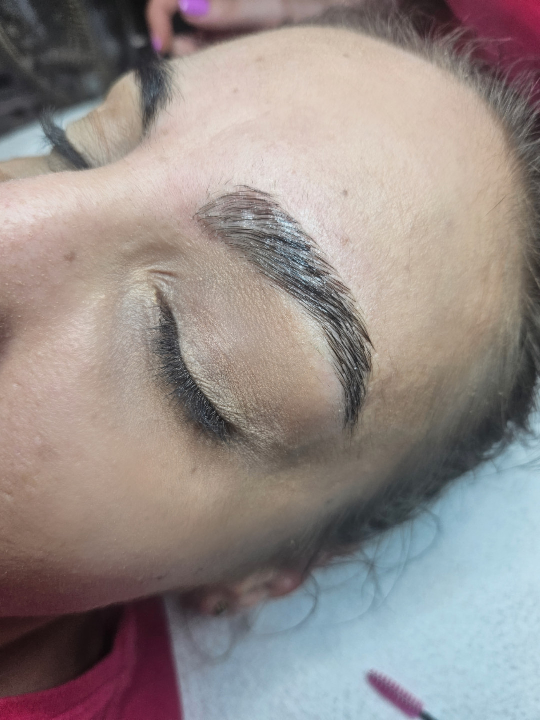 Brow lift - Starmedic, Beograd Trepavice Lice Trepavice, Beograd, Vračar, Čubura, Crveni krst