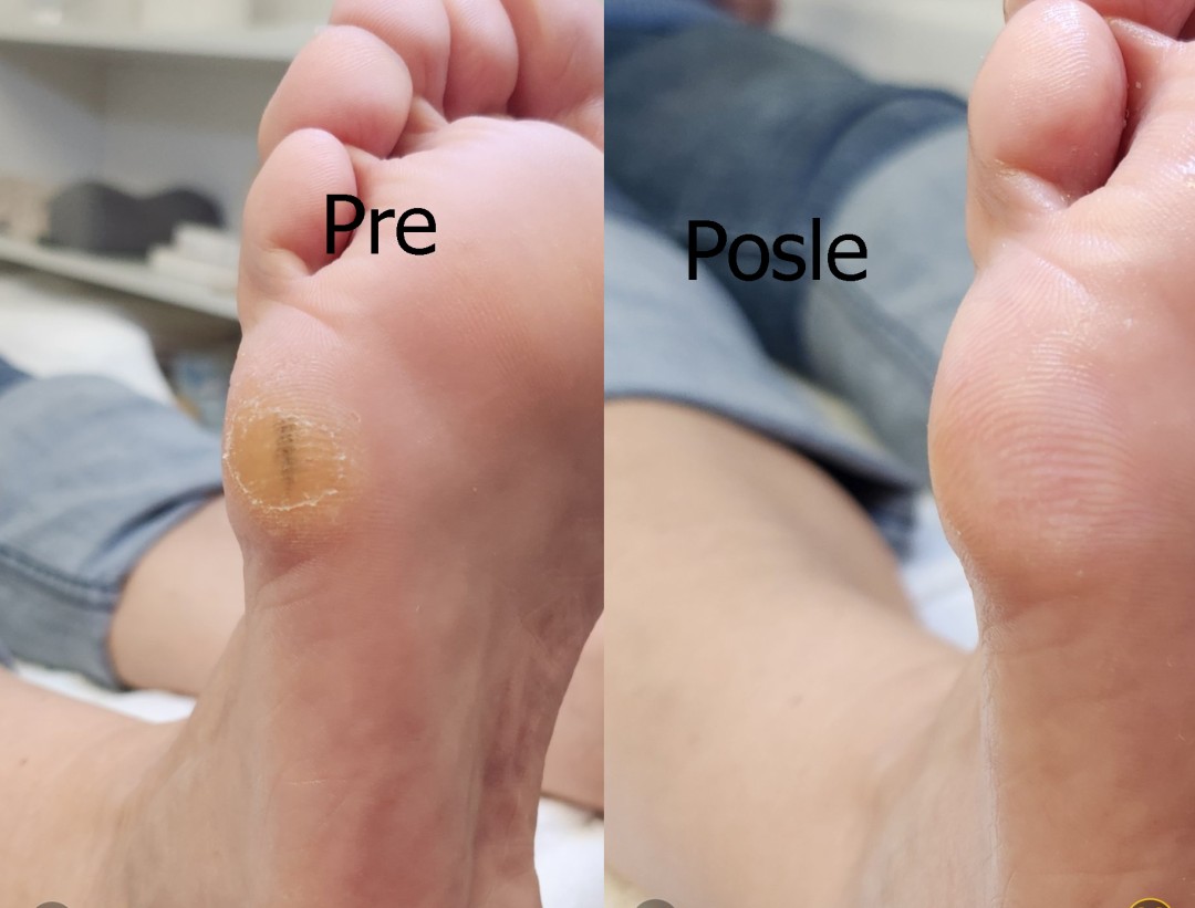 Bilja #beograd Medicinski pedikir Medicinski pedikir